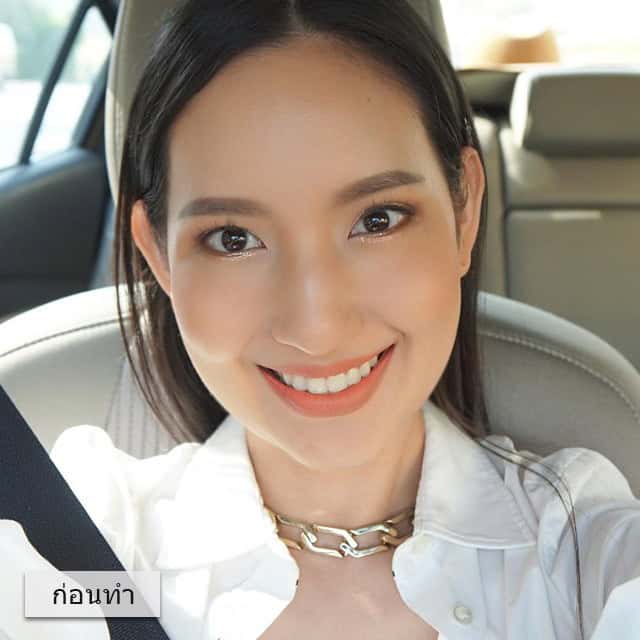 ULTHERA หมอมิ้ว เมโกะ คลินิก คุณพัด