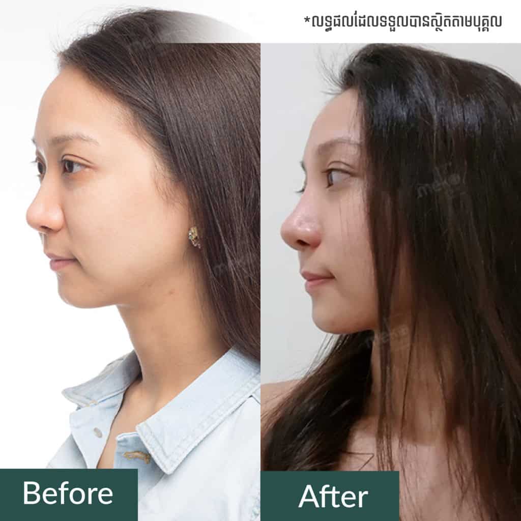 เสริมจมูก เปลี่ยนให้จมูกสโลป สวย ดูเด่นเป็นธรรมชาติ โดยแพทย์มนัส [คุณพิม]