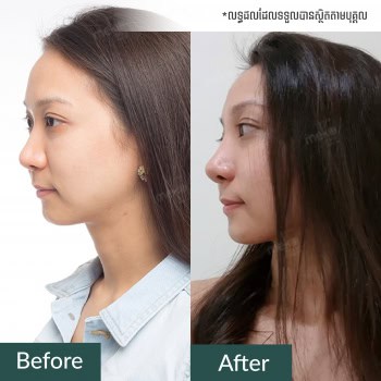 เสริมจมูก เปลี่ยนให้จมูกสโลป สวย ดูเด่นเป็นธรรมชาติ โดยแพทย์มนัส [คุณพิม]