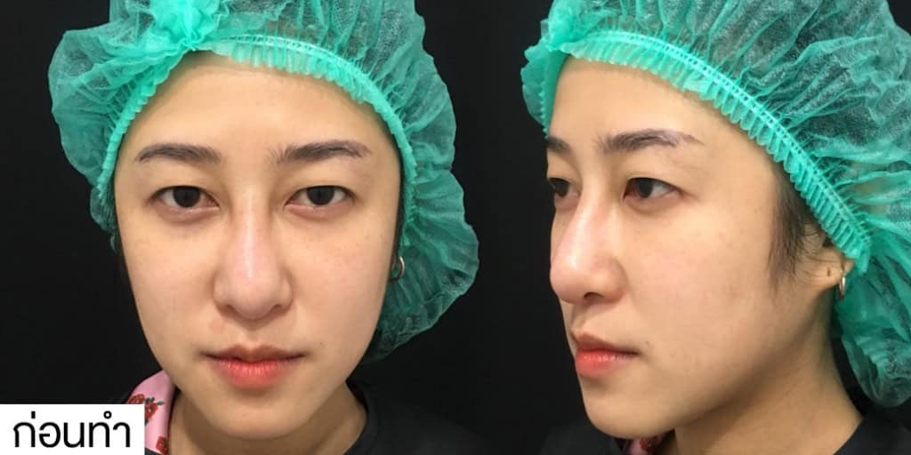 ตาสองชั้น หมอเอก เมโกะ คลินิก คุณเมย์