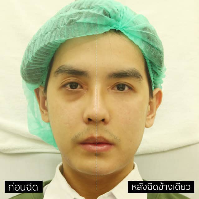 ฟิลเลอร์ หมออู๋ เมโกะ คลินิก คุณบอล let me in