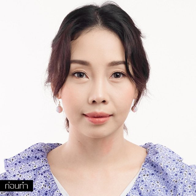 ฟิลเลอร์ หมอมิ้ว เมโกะ คลินิก คุณโบ๊ท