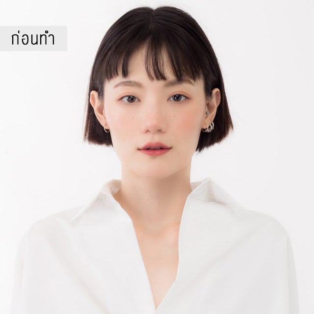 filler หมออู๋ เมโกะ คลินิก คุณเหมย