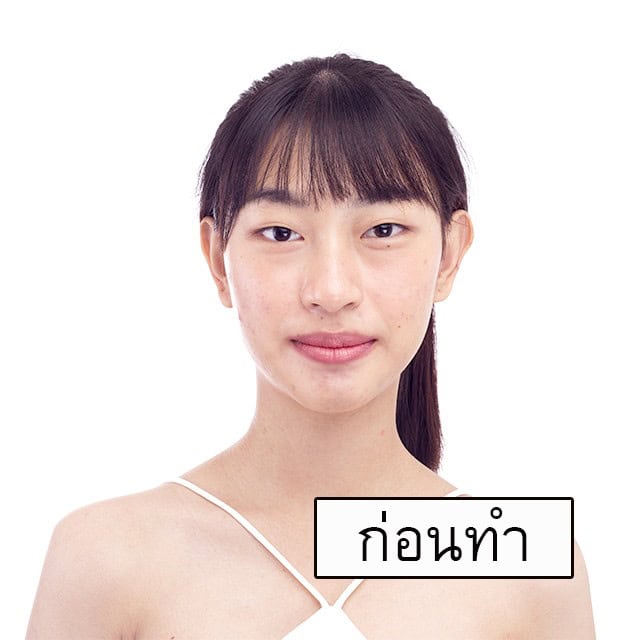 ตาสองชั้น หมอเอก เมโกะ คลินิก คุณเน็ต