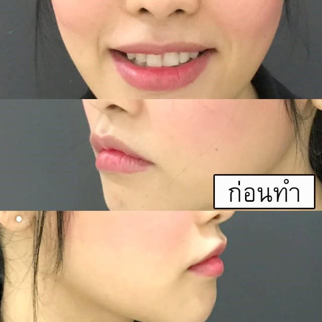 ยกมุมปาก หมออา เมโกะ คลินิก คุณแนน