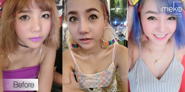 เสริมหน้าอก หมอยศ เมโกะ คลินิก คุณหญิง