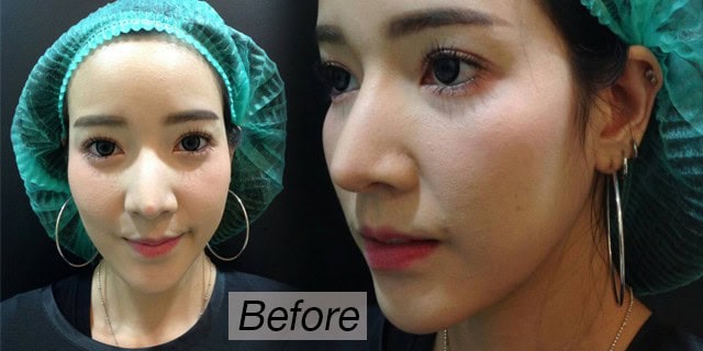 แก้จมูก หมอมนัส เมโกะ คลินิก คุณโบวี่