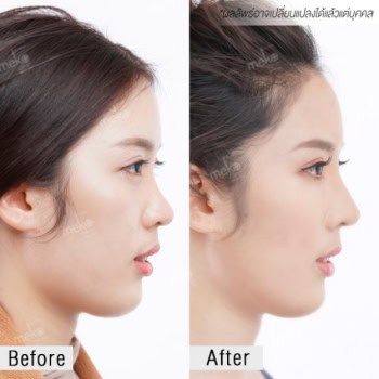 เสริมจมูก หมอยศ เมโกะ คลินิก คุณปอม