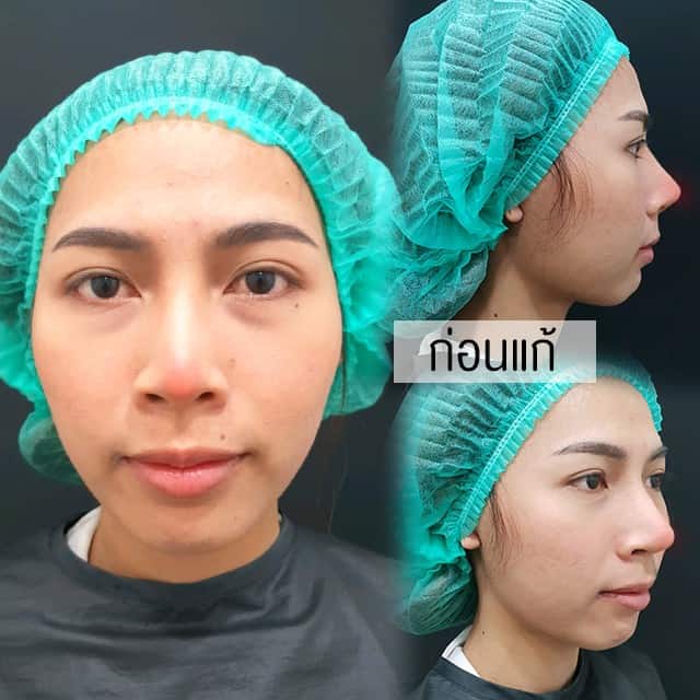 แก้จมูก หมอชัย เมโกะ คลินิก คุณปอ