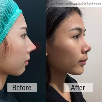 แก้จมูก หมอชัย เมโกะ คลินิก คุณปอ