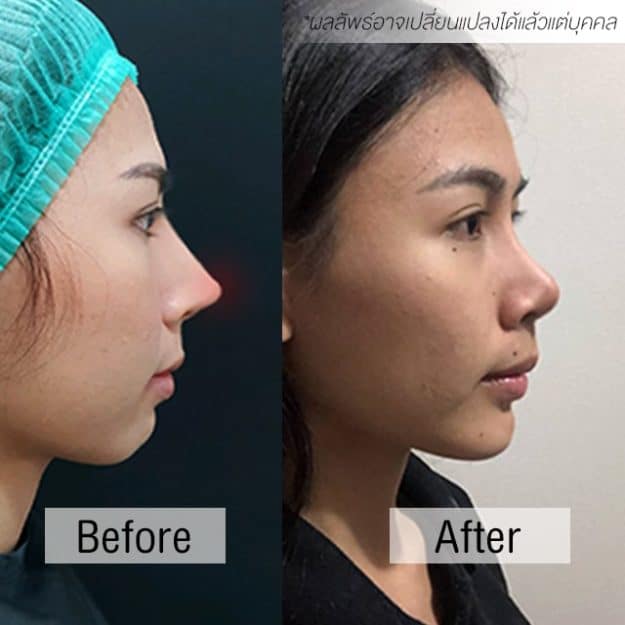 แก้จมูก หมอชัย เมโกะ คลินิก คุณปอ