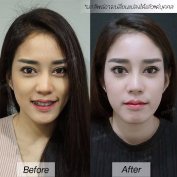 แก้จมู หมอมนัส เมโกะ คลินิก คุณทราย