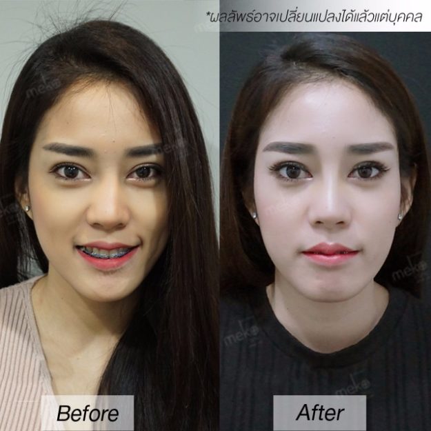 แก้จมู หมอมนัส เมโกะ คลินิก คุณทราย