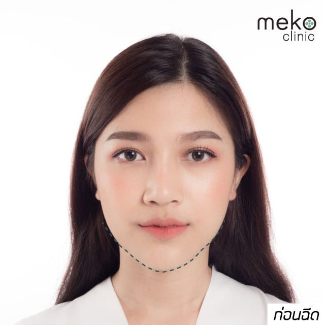 ฉีดโบ หมอฝน เมโกะ คลินิก คุณกัน