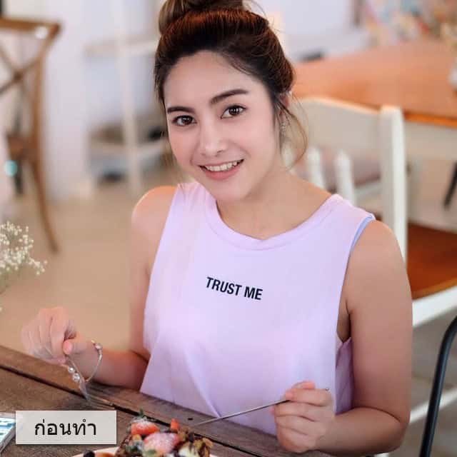 ฉีดโบ หมอมิ่ว เมโกะ คลินิก คุณเฟิร์น