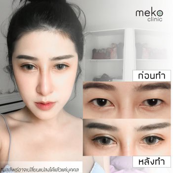 ตาสองชั้น หมอเอก เมโกะ คลินิก คุณเมย์