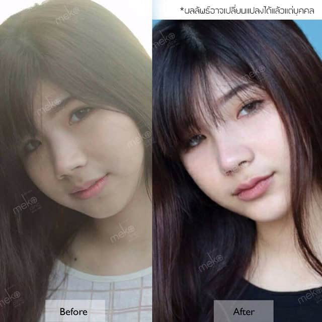 รีวิว เสริมจมูก เสริมคาง หมอยศ เมโกะ คลินิก คุณนุ่น