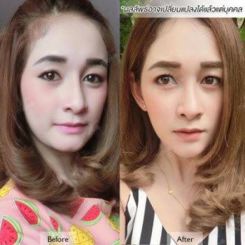 รีวิว เสริมคาง หมอยศ เมโกะ คลินิก คุณลูกตาล