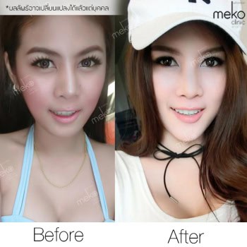 รีวิว เสริมคาง หมอยศ เมโกะ คลินิก คุณเอมมี่