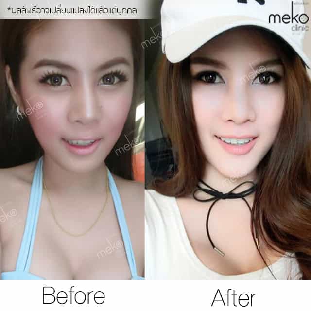 รีวิว เสริมคาง หมอยศ เมโกะ คลินิก คุณเอมมี่