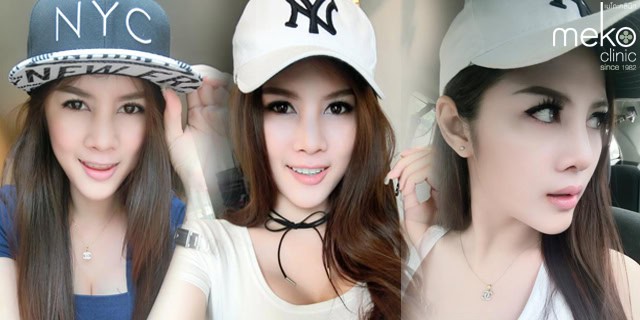 รีวิว เสริมคาง หมอยศ เมโกะ คลินิก คุณเอมมี่