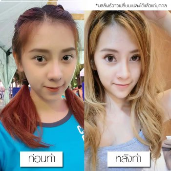 รีวิว เสริมคาง หมอยศ เมโกะ คลินิก คุณแพร