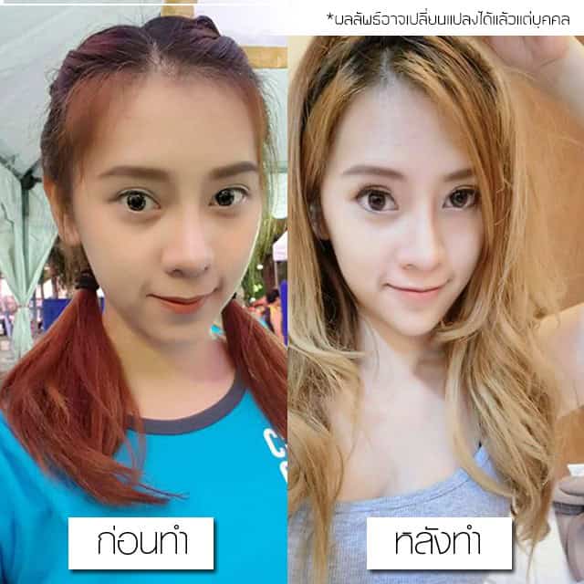 รีวิว เสริมคาง หมอยศ เมโกะ คลินิก คุณแพร