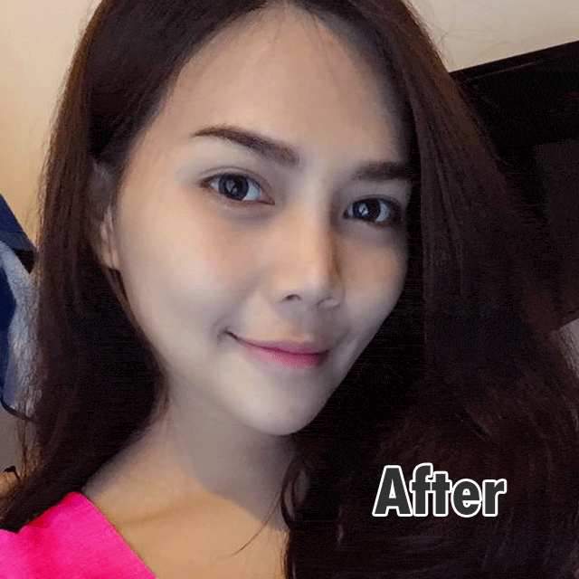 รีวิว เสริมจมูก เสริมคาง หมอยศ เมโกะ คลินิก คุณบอมเบย์