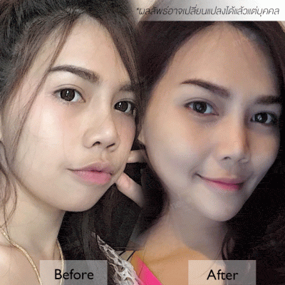 รีวิว เสริมจมูก เสริมคาง หมอยศ เมโกะ คลินิก คุณบอมเบย์