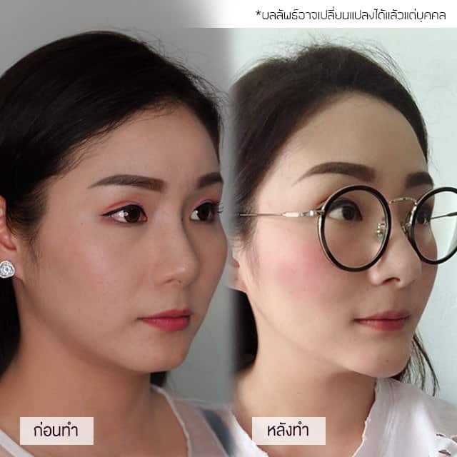 รีวิว เสริมคาง หมอยศ เมโกะ คลินิก คุณเล็ก