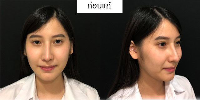 แก้จมูก หมอยศ เมโกะ คลินิก คุณเจน