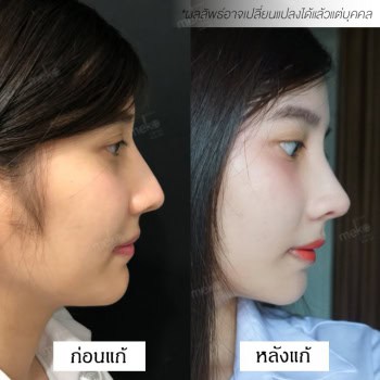 แก้จมูก หมอยศ เมโกะ คลินิก คุณเจน