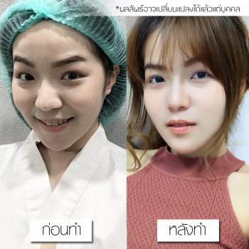 เสริมคาง ทำคาง หมอยศ เมโกะ คลินิก คุณจุ๊ (17)