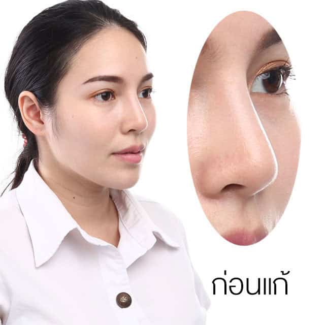 แก้จมูก หมอยศ เมโกะ คลินิก คุณหญิง