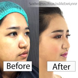 เสริมจมูก-หมอมนัส-เมโกะ-คลินิก-คุณนัท