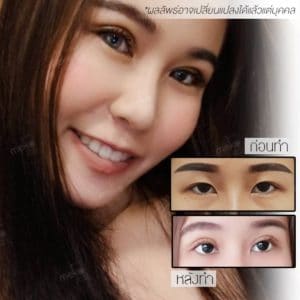 ทำตาสองชั้น ให้สวยคมชัด สยบชั้นตาหลบใน โดยแพทย์ศักดิ์ [คุณพลอยธนกาญจน์]