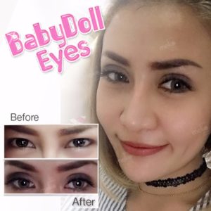 ทำตาสองชั้น ชั้นตาชัด เส้นโค้ง คมสวย โดยแพทย์ศักดิ์ [คุณปลา]