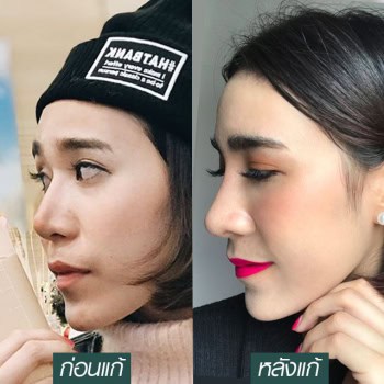 เสริมจมูก แก้เพราะหน้าแข็ง ให้หวานละมุน โดยแพทย์มนัส [คุณบู]