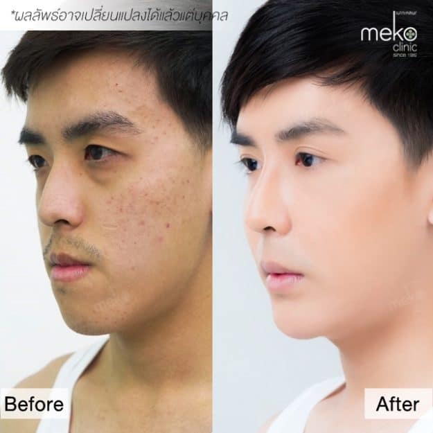 บอล LET ME IN 3 เสริมจมูก โดยแพทย์มนัส [คุณโซจู]