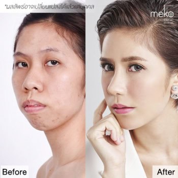 เสริมจมูก กิ๊บก๊าบ LET ME IN 3 โดยแพทย์มนัส [ คุณกิ๊บก๊าบ ]