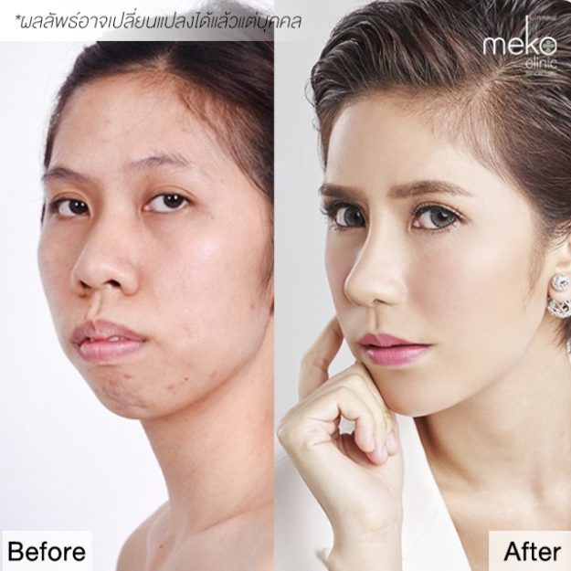 เสริมจมูก กิ๊บก๊าบ LET ME IN 3 โดยแพทย์มนัส [ คุณกิ๊บก๊าบ ]