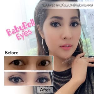 ตาสองชั้น ชั้นชัด เส้นคม โค้งสวย โดยแพทย์ศักดิ์ [คุณนิดนึง]