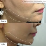 Endotine ยกกระชับปรับหน้าเด็ก โดยแพทย์ยศ [คุณมะเหมี่ยว]