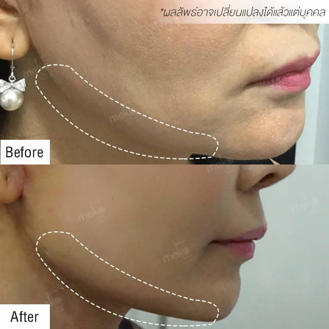 Endotine ยกกระชับปรับหน้าเด็ก โดยแพทย์ยศ [คุณมะเหมี่ยว]