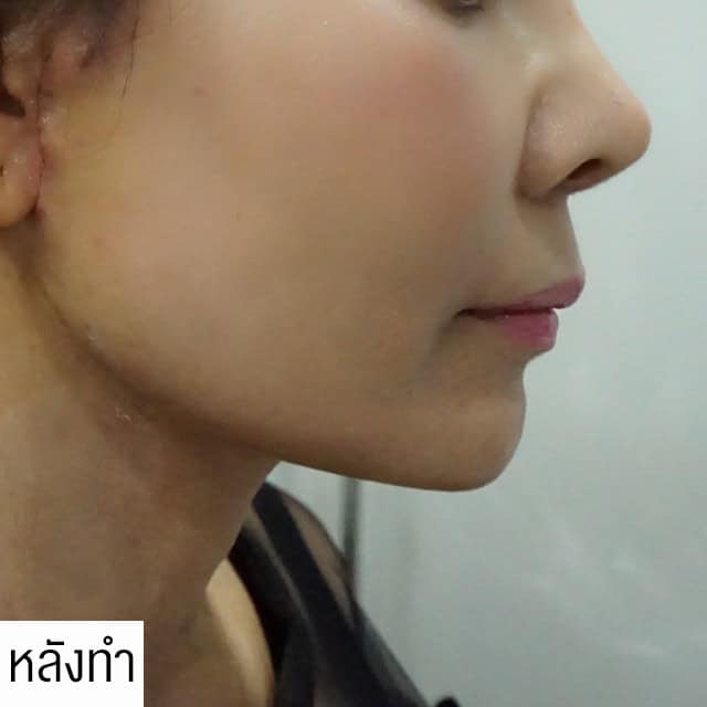 หลังทำ Endotine หมอยศ เมโกะคลินิก คุณมะเหมี่ยว