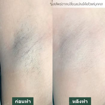 กำจัดขน หมอมิ้ว เมโกะ คลินิก คุณเบียร์