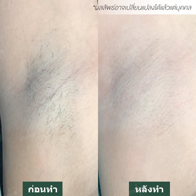 กำจัดขน หมอมิ้ว เมโกะ คลินิก คุณเบียร์