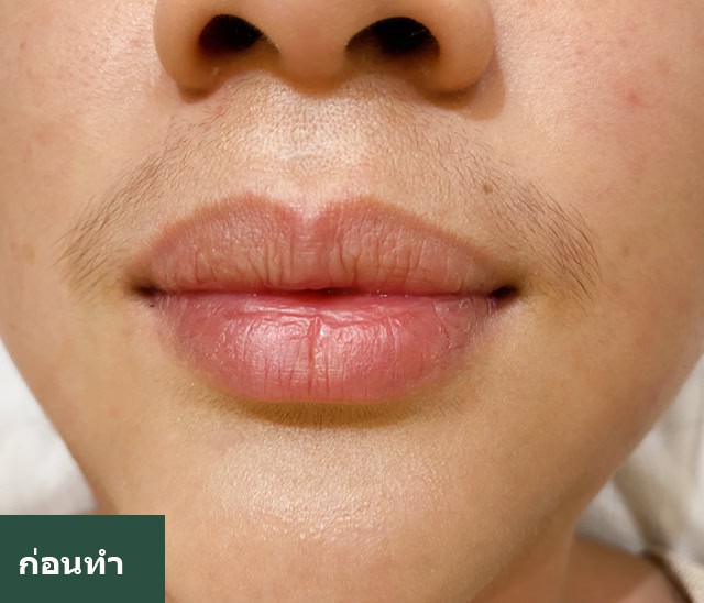 กำจัดขน หมอเอ๋ เมโกะ คลินิก