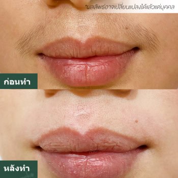 กำจัดขน หมอเอ๋ เมโกะ คลินิก