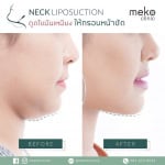 ดูดไขมันเหนียงให้กรอบหน้าชัด-1